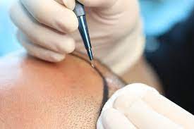 زراعة الشعر تقنية السفير